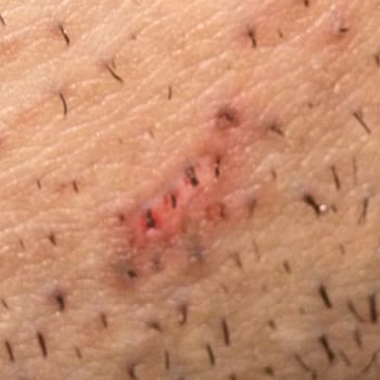 14.000 TL'lik Lazer Epilasyon Paketi Yanık Ve İz Bırakarak Söz Verilen Sonuçları Vermedi