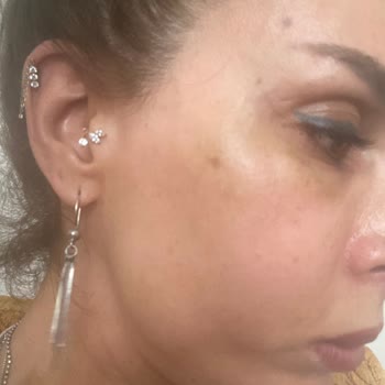 Yetkisiz Botoks Ve Dolgu Sonrası Şiddetli Sağlık Problemleri Ve Ücret İadesi Talebi