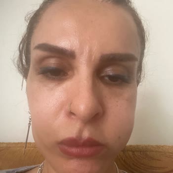 Yetkisiz Botoks Ve Dolgu Sonrası Şiddetli Sağlık Problemleri Ve Ücret İadesi Talebi