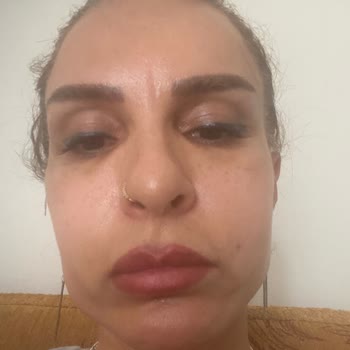 Yetkisiz Botoks Ve Dolgu Sonrası Şiddetli Sağlık Problemleri Ve Ücret İadesi Talebi