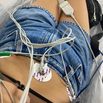 Yetkisiz Botoks Ve Dolgu Sonrası Şiddetli Sağlık Problemleri Ve Ücret İadesi Talebi