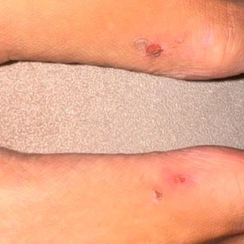 Kaygan Taban Ve Sürtünme Yapan Deri Sandalette İlk Kullanımda Yaralanma