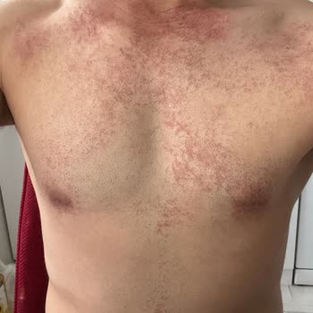 Bioder Bitkisel Tüy Dökücü Sprey Kullanımında Ciltte Şiddetli Yanma Ve Yanık