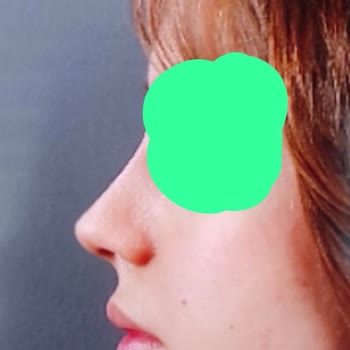 Burun Estetiği Sonrası Burun Ucu Yok, Nefes Alma Problemi Ve Doktorun İlgisiz Tutumu