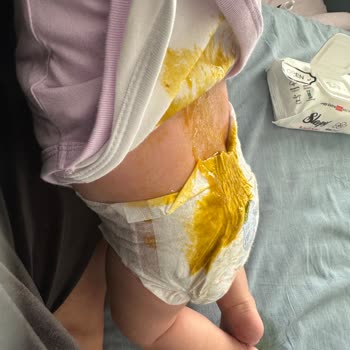 Molfix Bebek Bezinde Sızdırma Ve Taşma Sorunu