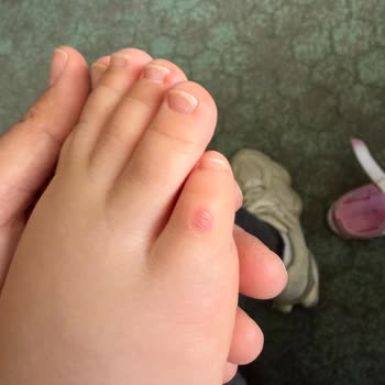 Sert Dikişli Sandalet Çocuğumun Ayağını Yaraladı