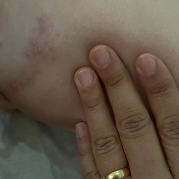 Klamoks Antibiyotiği Sonrası Çocuğumda Şiddetli Döküntü Ve Kaşıntı