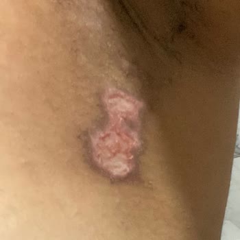 Lazer Epilasyon Söz Verdiği Sonuçları Vermedi Ve Yanıklara Neden Oldu
