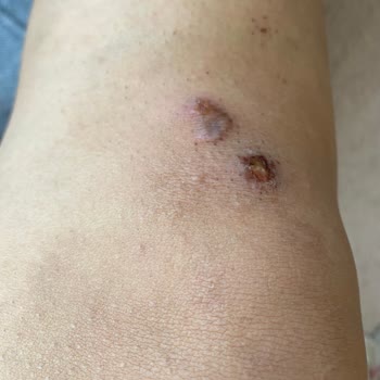 Lazer Epilasyon Söz Verdiği Sonuçları Vermedi Ve Yanıklara Neden Oldu