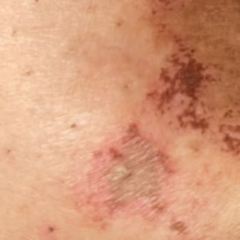 Lazer Epilasyon Söz Verdiği Sonuçları Vermedi Ve Yanıklara Neden Oldu
