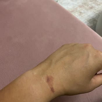 Lazer Epilasyon Söz Verdiği Sonuçları Vermedi Ve Yanıklara Neden Oldu