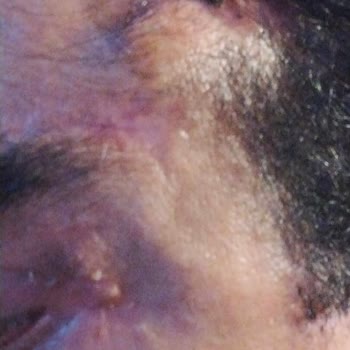 Estetik Cerrahi Sonrası Yaşanan Komplikasyonlar ve Şikayet