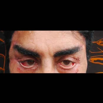 Estetik Cerrahi Sonrası Yaşanan Komplikasyonlar ve Şikayet