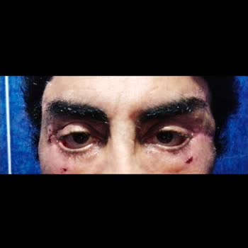 Estetik Cerrahi Sonrası Yaşanan Komplikasyonlar ve Şikayet