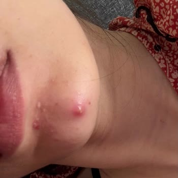Pure Korean Kağıt Maskesi Çene Bölgesinde İltihaplı Sivilceler Oluşturdu