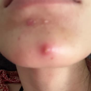 Pure Korean Kağıt Maskesi Çene Bölgesinde İltihaplı Sivilceler Oluşturdu