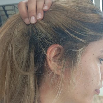 Saç Boyama Sonrası Yanık Ve Saç Dökülmesi İçin Ücret İadesi Ve Tedavi Masrafı Talebi