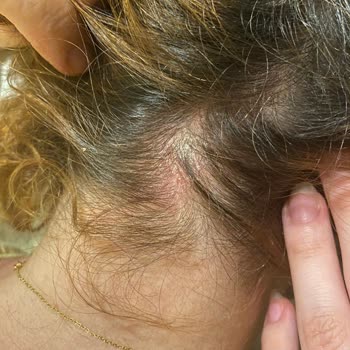 Bioxcin Forte Şampuanı Kafa Derisinde Şiddetli Kaşıntı Ve Kızarıklığa Neden Oldu