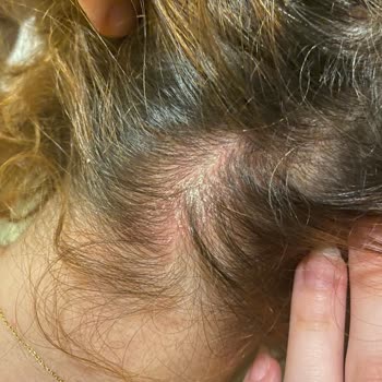 Bioxcin Forte Şampuanı Kafa Derisinde Şiddetli Kaşıntı Ve Kızarıklığa Neden Oldu