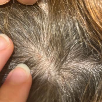 Bioxcin Forte Şampuanı Kafa Derisinde Şiddetli Kaşıntı Ve Kızarıklığa Neden Oldu