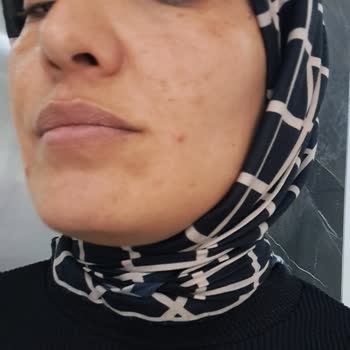 Balım Eczanesi'nden Alınan Caudalie Seti Şiddetli Sivilcelere Sebep Oldu