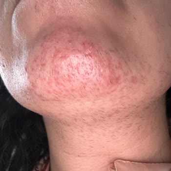 Uzm. Emel Demir İşlemler Cildime Zarar Verdi Yaptıklarını Kabul Etmiyorlar