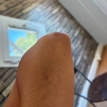 Balçova Hastanesi Dermatolojide Lazer Epilasyonda Kıllarda Artış Ve Koyu Renk