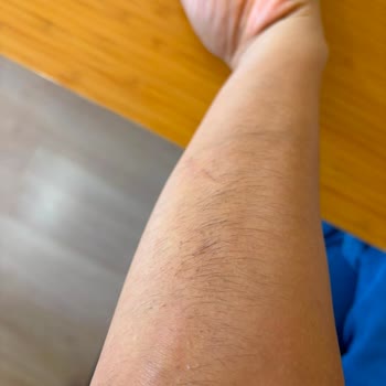 Balçova Hastanesi Dermatolojide Lazer Epilasyonda Kıllarda Artış Ve Koyu Renk