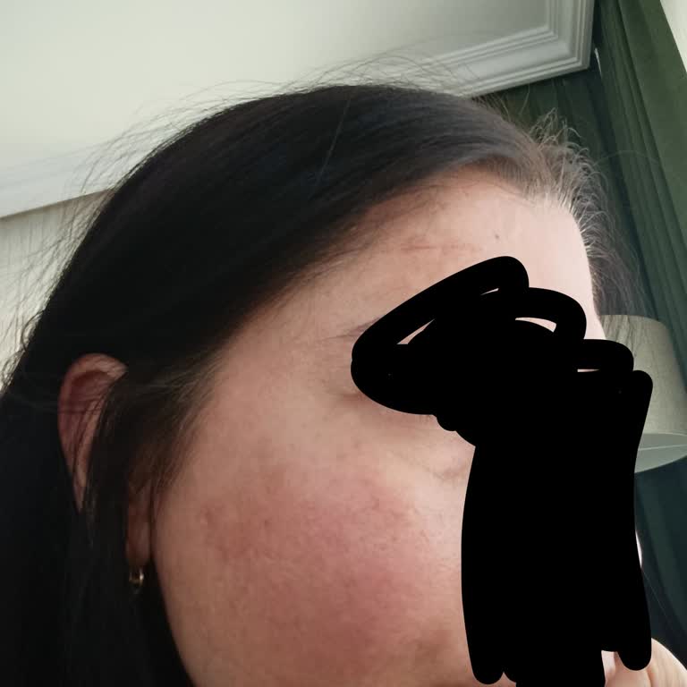 La Roche Posay Cicaplast Kremi Yüzümde Aşırı Yağlı Parlaklık Ve Şiddetli Tahriş Yarattı
