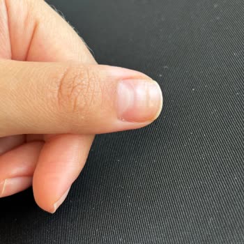 Hijyenik Olmayan Protez Tırnak İşlemi Sonrası Uzun Süreli Sağlık Sorunu