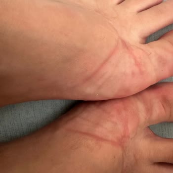 Defolu Sandalet Ve Ayak Tahrişi Nedeniyle İade Talebi