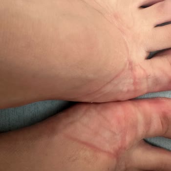Defolu Sandalet Ve Ayak Tahrişi Nedeniyle İade Talebi