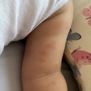 Hipp 3 Devam Sütündeki Alerjik Reaksiyon Ve Şirketin Çözüm İhmalı
