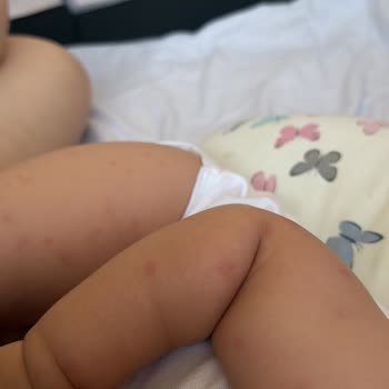 Hipp 3 Devam Sütündeki Alerjik Reaksiyon Ve Şirketin Çözüm İhmalı