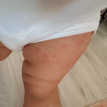 Hipp 3 Devam Sütündeki Alerjik Reaksiyon Ve Şirketin Çözüm İhmalı