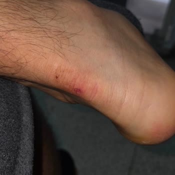 Skechers Ayakkabısındaki Topuk Demiri Açığa Çıktı, Müşteri Hatası İddiası Reddedildi