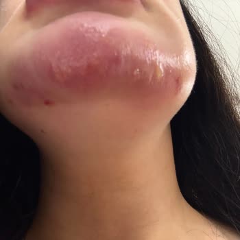 Dolgu Ve Botoks Sonrası Şiddetli Enfeksiyon Ve Klinik Sorumluluğu Reddi