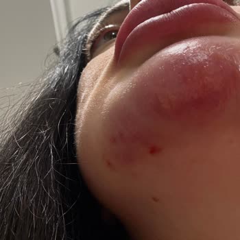 Dolgu Ve Botoks Sonrası Şiddetli Enfeksiyon Ve Klinik Sorumluluğu Reddi