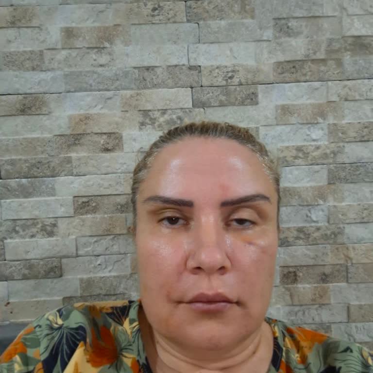 Cosmetolog Aliyeva Az Hem Sağlık Hem Psikolojik Olarak Çok Yıprandım