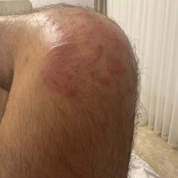 Araçta Tahta Kurusu Isırığı Nedeniyle Sağlık Sorunu Ve Telafi Talebi