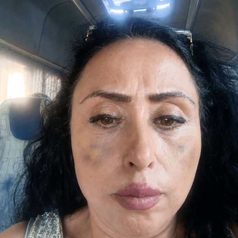 Bahçelievler Şubesinde Yanıltıcı Rejuran Ve Altın İğne İşlemi Sonrası Şiddetli Morluk Ve İade Talebi