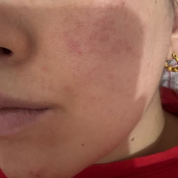 Hydra Water Plump BB Krem 50 SPF'te Cilt Alerjisi Ve İade Talebi