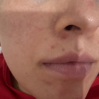 Hydra Water Plump BB Krem 50 SPF'te Cilt Alerjisi Ve İade Talebi