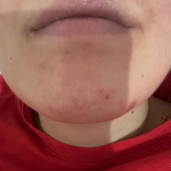 Hydra Water Plump BB Krem 50 SPF'te Cilt Alerjisi Ve İade Talebi