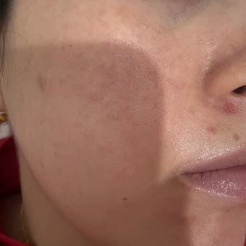 Hydra Water Plump BB Krem 50 SPF'te Cilt Alerjisi Ve İade Talebi