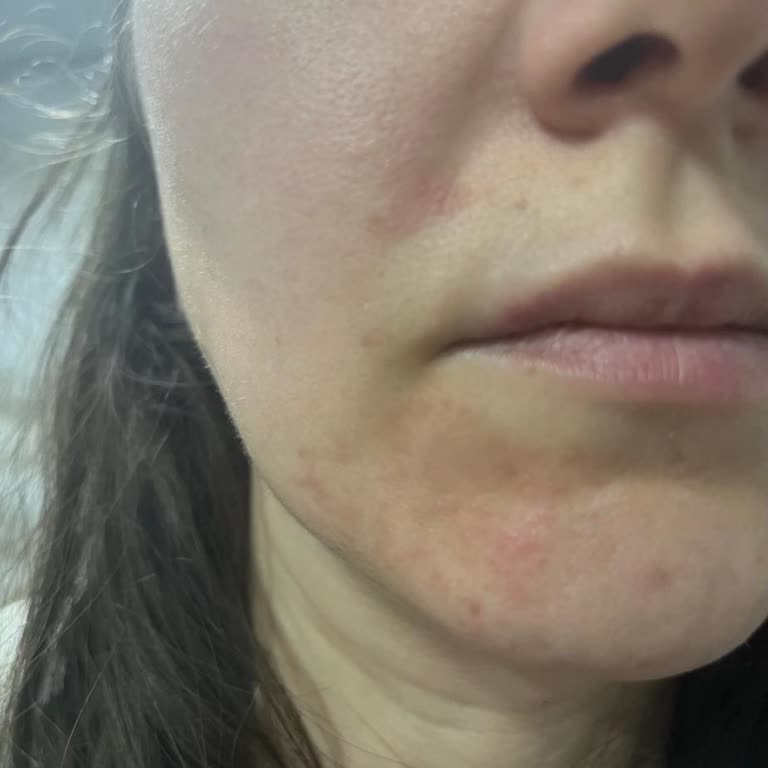 Caudalie Ürünlerinde Yanma Ve Kızarıklık Nedeniyle İade Talebi