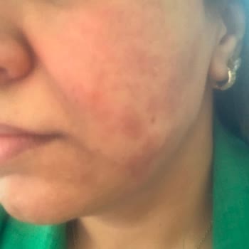Sinoz Vitamin C Causa Quemadura y Manchas en la Piel, Solicito Reembolso