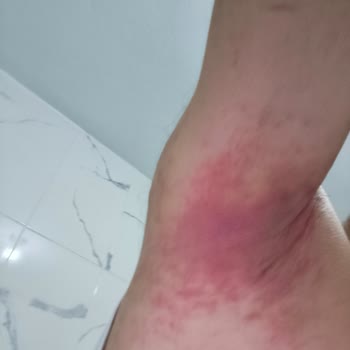 Veet Tüm Ciltler İçin Kremi Yanma Ve Kaşıntıya Yol Açtı