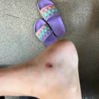 Oxelo Kids Fit3 Pateni Çocuklarda Ağır Ayak Tahrişi Ve Güvenlik Sorunu