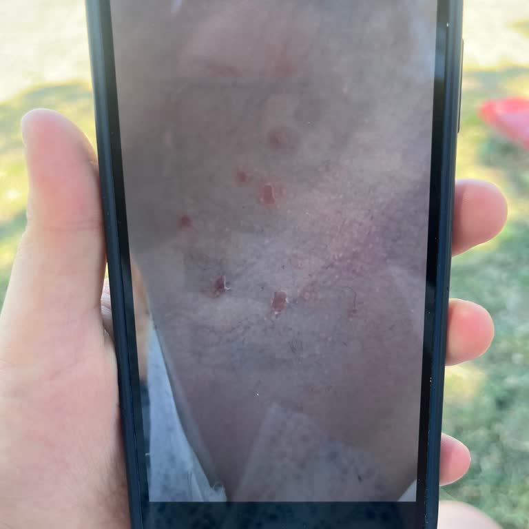 Üçüncü Derece Yanık Ve Sürekli Arama Tacizine Son İstiyorum